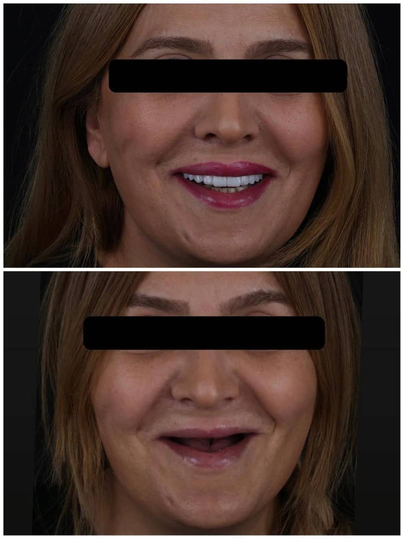گالری دندان